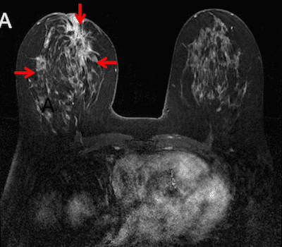 Рак молочной железы на МРТ
